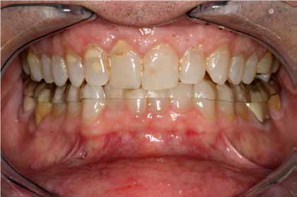 患者佩戴可摘𬌗垫来避免牙齿接触损害.png