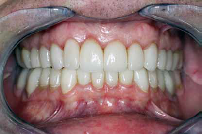 所有28颗牙齿均用瓷修复替代；显示牙龈组织改善.png