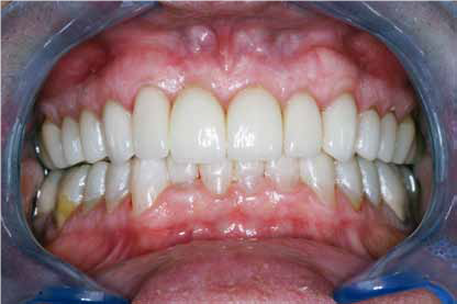 上颌牙齿用瓷来替代修复，下颌佩戴矫正器.png